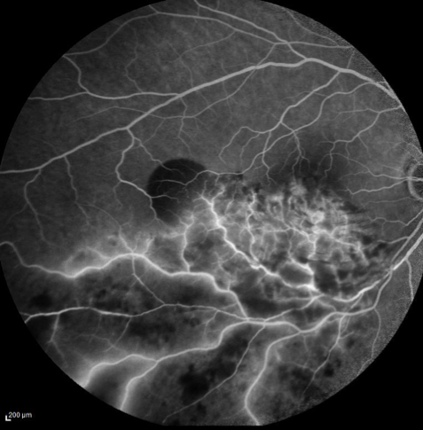 https://www.centrevision-lyon.fr/wp-content/uploads/2021/03/Angiographie-a-la-fluoresceine-occlusion-de-branche-veineuse.png