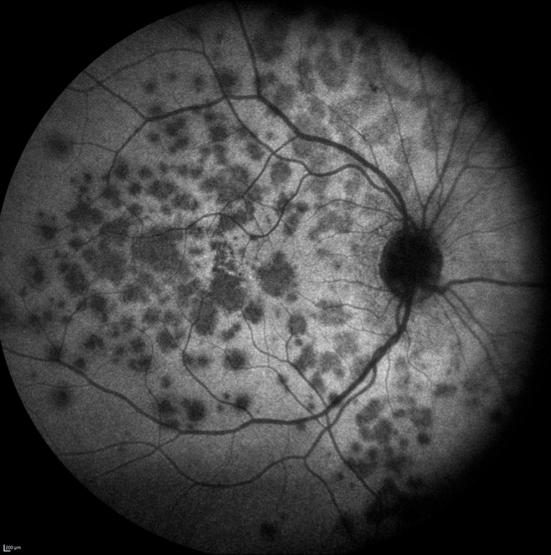 https://www.centrevision-lyon.fr/wp-content/uploads/2021/03/Autofluorescence-syndrome-des-taches-blanches-evanescentes.png