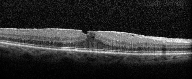 https://www.centrevision-lyon.fr/wp-content/uploads/2021/03/Tomographie-en-coherence-optique-membrane-epiretinienne.png