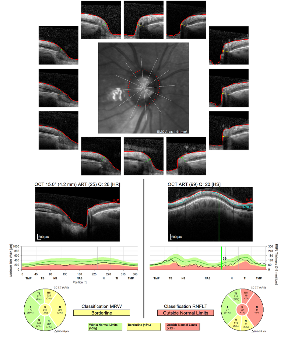 https://www.centrevision-lyon.fr/wp-content/uploads/2021/03/Tomographie-en-coherence-optqiue-analyse-de-lepaisseur-de-la-tete-du-nerf-optique-et-de-lepaisseur-des-fibres-peripapillaires.png